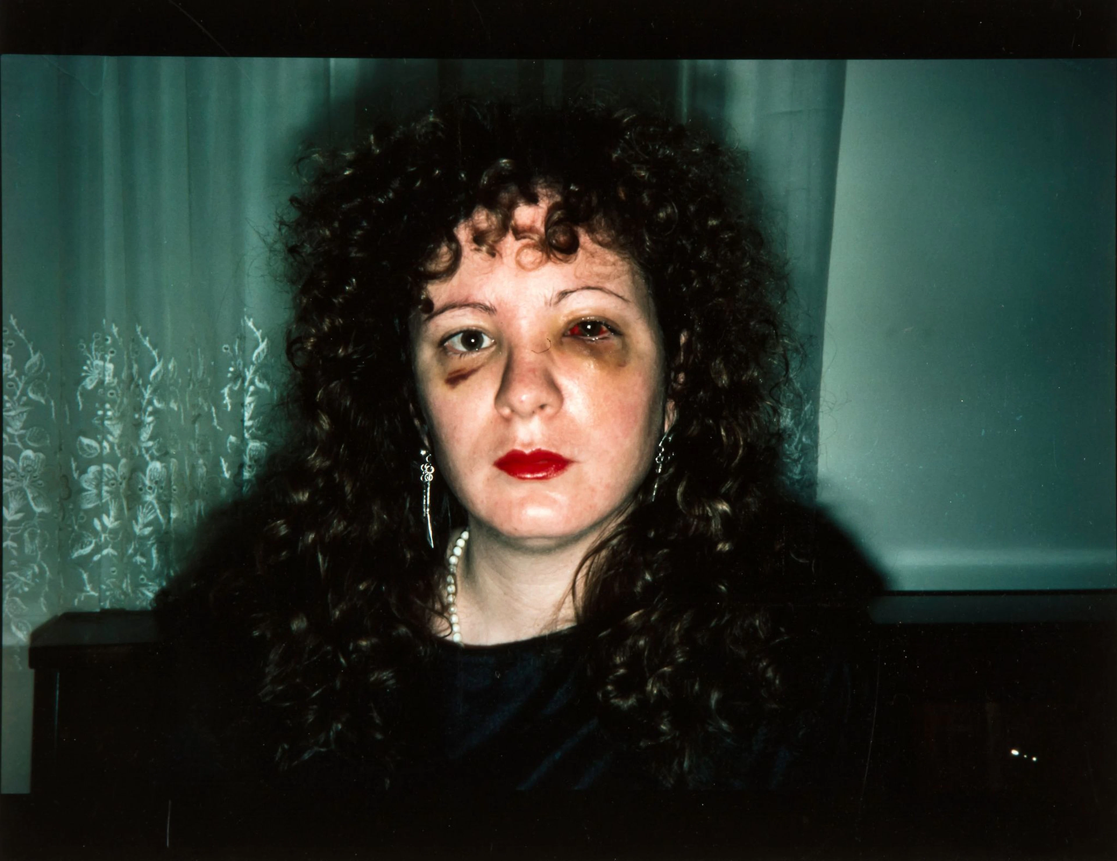 Nan Goldin (b.1954) - Self-Portrait after Being Battered, 1984